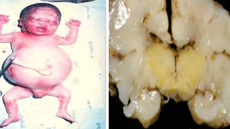 Biểu hiện đặc trưng của bệnh tan máu bẩm sinh ở trẻ