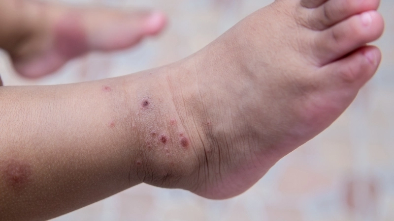 Tay chân miệng mức độ 1 ít khi gây biến chứng nguy hiểm