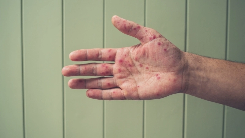 Biểu hiện bệnh tay chân miệng ở trẻ cấp độ 1