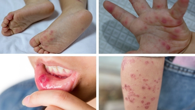 Hình ảnh bệnh tay chân miệng ở trẻ sơ sinh cần chú ý