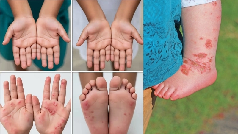 Điều trị bệnh tay chân miệng cấp độ 1 tập trung vào triệu chứng