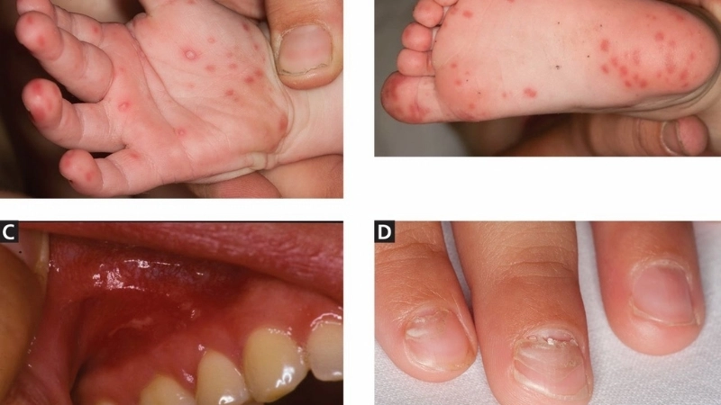 Bệnh tay chân miệng cấp độ 1 đặc trưng bởi nốt ban đỏ