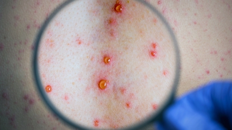 Dấu hiệu qua hình ảnh bé bị thủy đậu