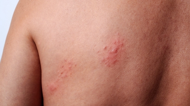 So sánh hình ảnh thủy đậu ở người lớn và trẻ em