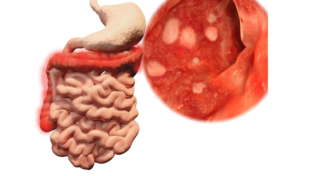 Chế độ dinh dưỡng khoa học cho người bị tiêu chảy