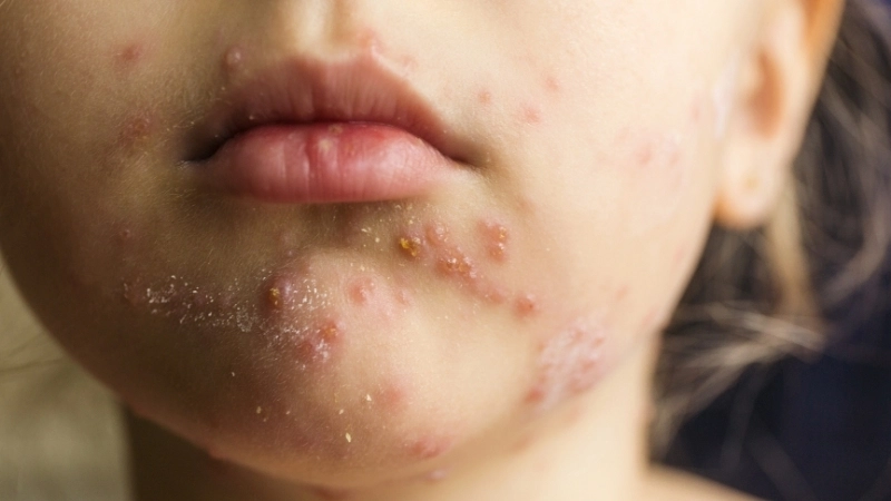 Cách chữa bệnh trái rạ nhanh nhất bằng việc giữ vệ sinh da