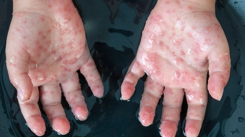 Cận cảnh một nốt trái rạ đang chứa dịch trong