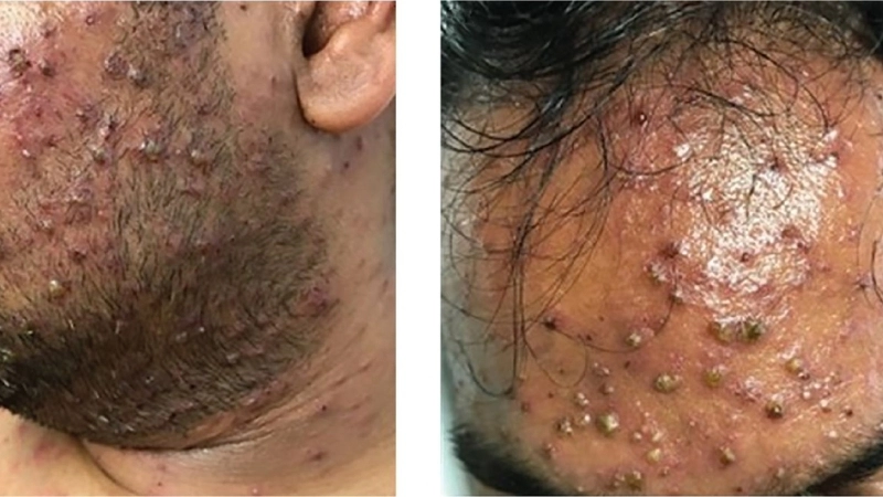 Biểu hiện bệnh trái rạ ở người lớn và các biến chứng