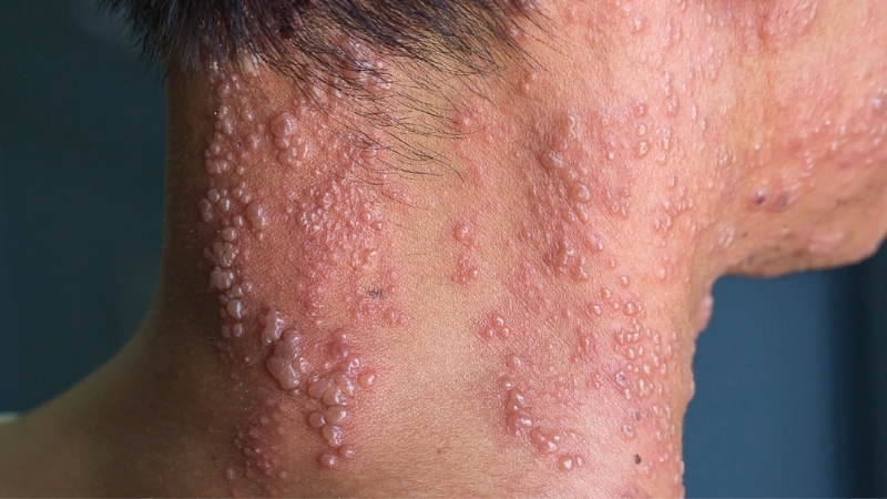 Sơ đồ cho thấy bệnh trái rạ có lây không qua tiếp xúc