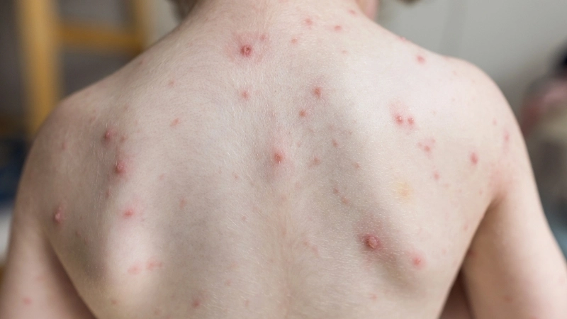 Quá trình các nốt trái rạ đóng vảy và hồi phục da