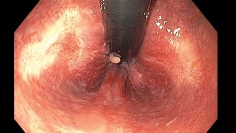 Mô tả chi tiết hình ảnh của bệnh trĩ