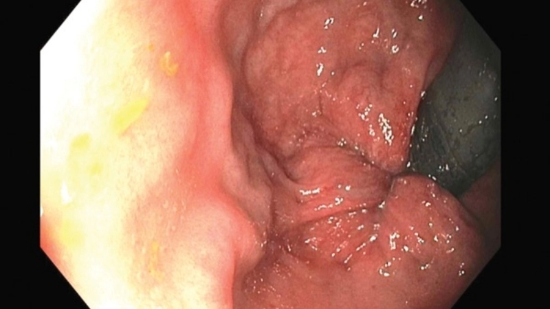 Biểu hiện qua ảnh bệnh trĩ ngoại nhẹ