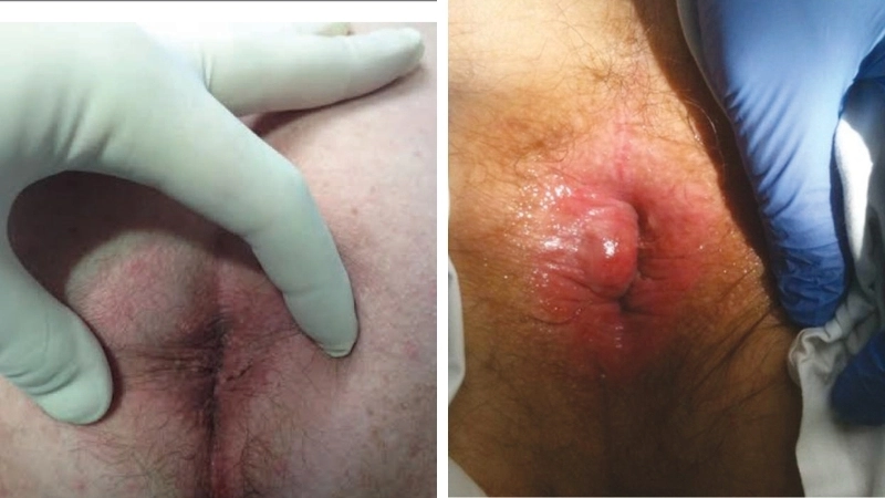 Nhận biết qua hình ảnh bệnh trĩ ở nam giới