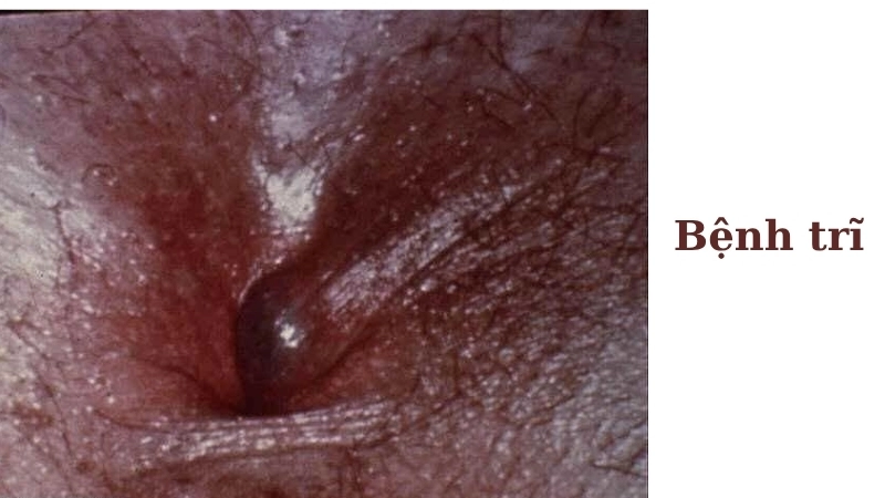 Dấu hiệu nhận biết qua hình ảnh bệnh trĩ giai đoạn đầu