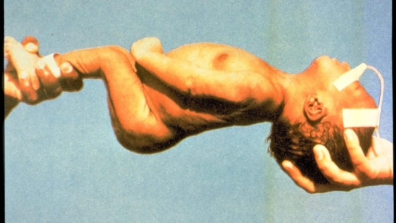 Biểu đồ về thời gian ủ bệnh uốn ván