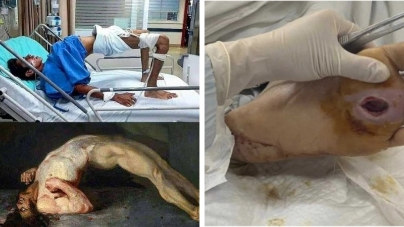 Hình ảnh vết thương có nguy cơ cao bị uốn ván