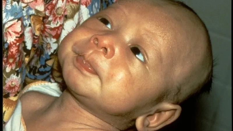 Vắc-xin uốn ván là biện pháp phòng ngừa hiệu quả