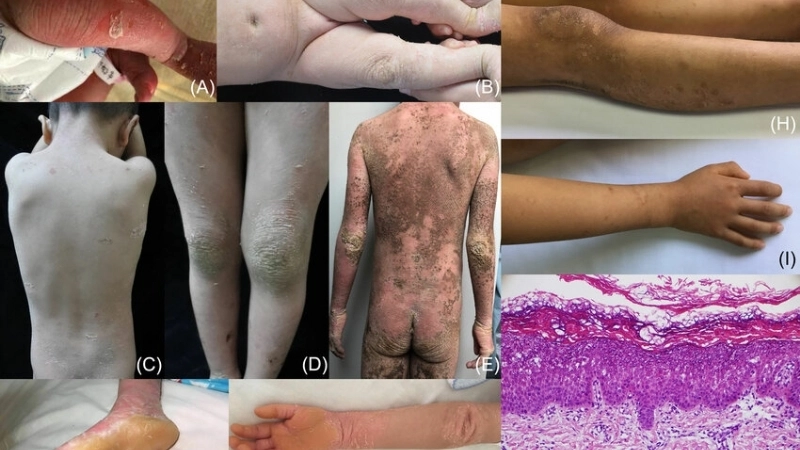 Triệu chứng bệnh vảy cá với các mảng da khô và bong tróc