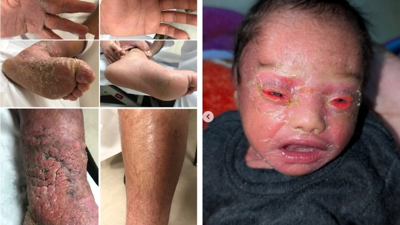 Minh họa cách chữa bệnh vảy cá bằng phương pháp dưỡng ẩm sâu