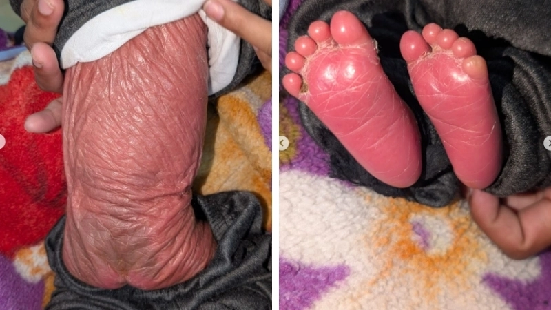 Biểu hiện của bệnh vảy cá bẩm sinh trên da trẻ sơ sinh