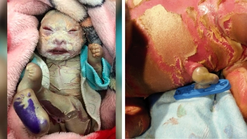 Giải đáp thắc mắc bệnh vảy cá có di truyền không qua gen