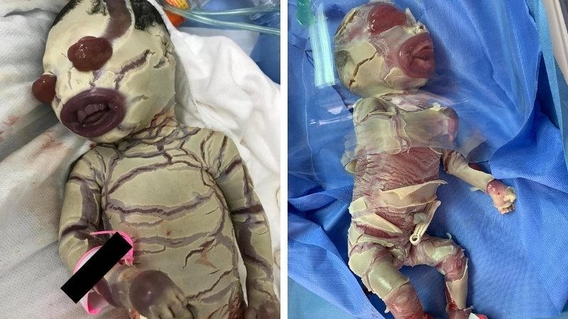 Chăm sóc đặc biệt cho bệnh vảy cá ở trẻ em