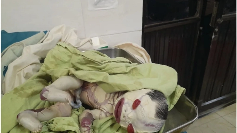 Khẳng định bệnh vảy cá có lây không: Bệnh không lây nhiễm