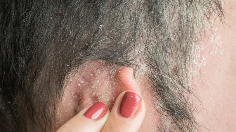 Cách trị vảy nến da đầu bằng việc giữ da đầu luôn đủ ẩm