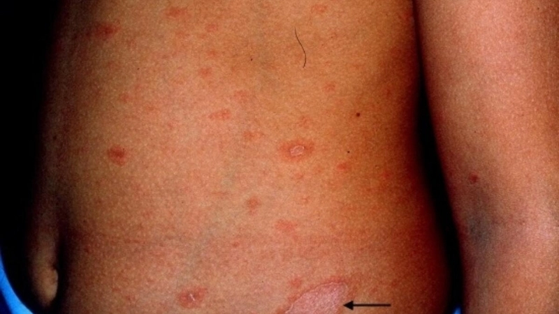 Các loại thuốc bôi vảy phấn hồng thường được bác sĩ chỉ định