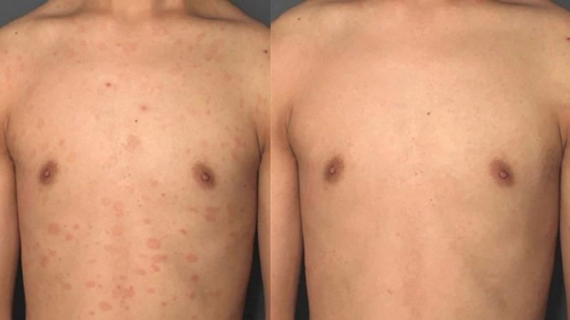 Giải đáp thắc mắc vảy phấn hồng có lây không qua infographic