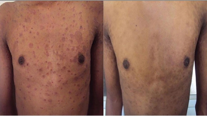 Theo dõi bệnh vảy phấn hồng bao lâu thì khỏi qua từng giai đoạn