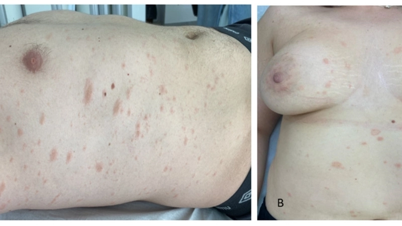 Cách phân biệt vảy phấn hồng và hắc lào qua hình ảnh