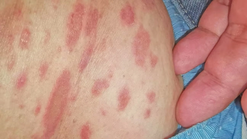 Tổn thương da hình bầu dục có vảy mịn ở trung tâm