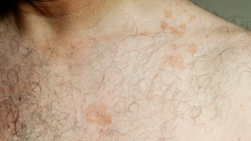 Hình ảnh lâm sàng điển hình của bệnh vảy phấn hồng Gibert với mảng hồng ban ban đầu.