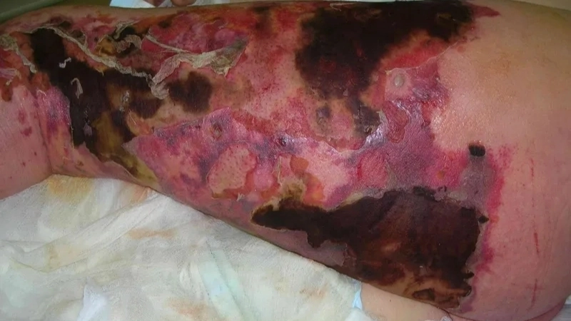 Nguy cơ khi ăn hàu sống bị nhiễm khuẩn