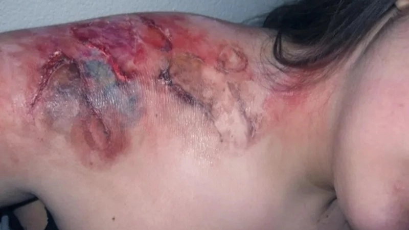 Tổn thương da do nhiễm liên cầu lợn