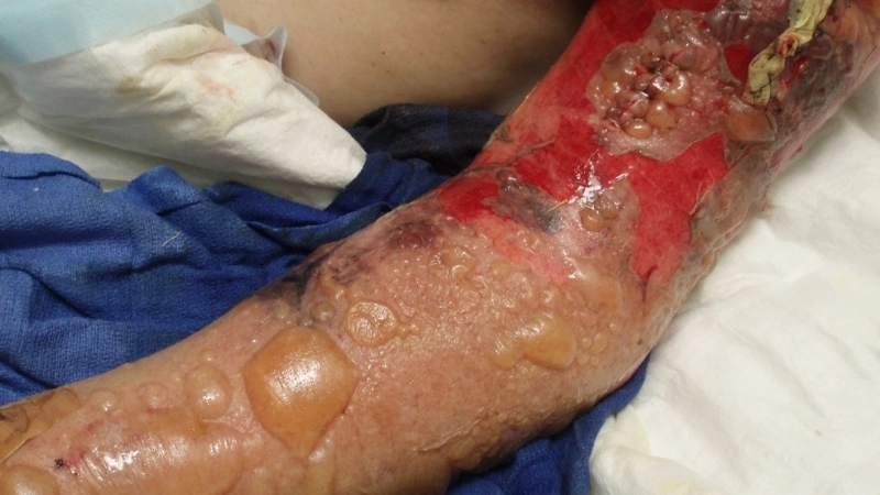 Hình ảnh hoại tử mô mềm do vi khuẩn