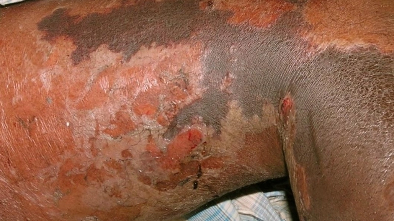 Cảnh báo các dấu hiệu nhiễm vi khuẩn ăn thịt người