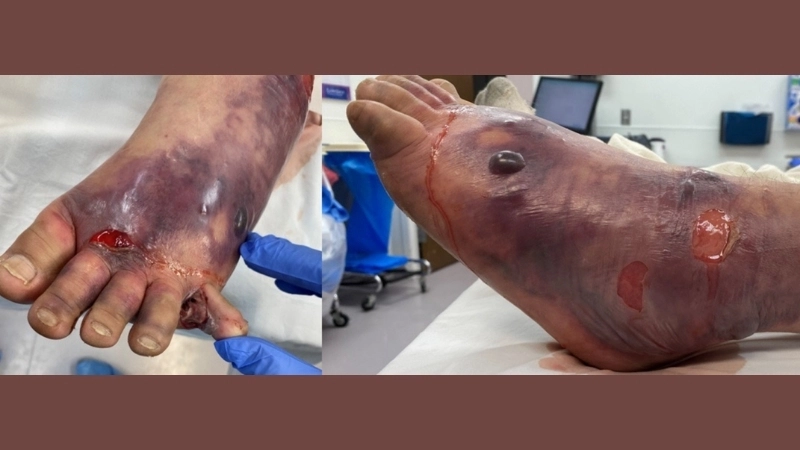 Phân biệt vết thương nhiễm trùng thường và hoại tử