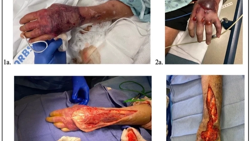 Dấu hiệu nhiễm vi khuẩn ăn thịt người giai đoạn đầu với vùng da sưng đỏ