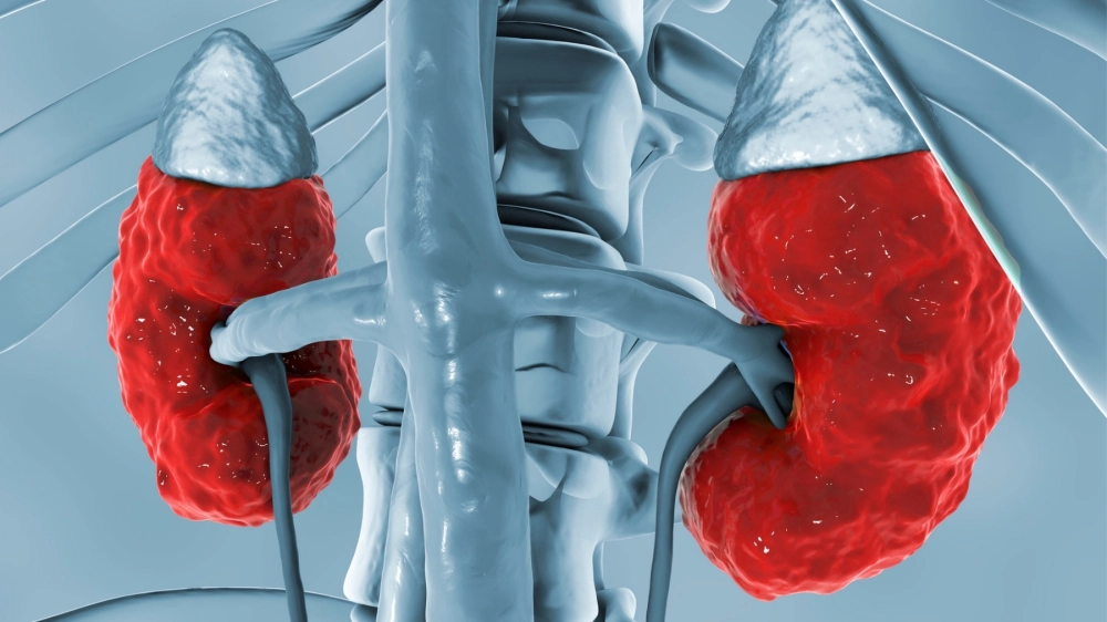 Tìm hiểu nguyên nhân viêm cầu thận phổ biến