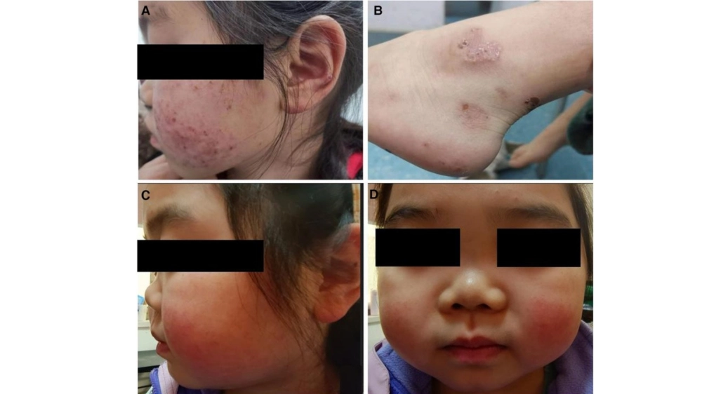 Biểu hiện của hội chứng thận hư