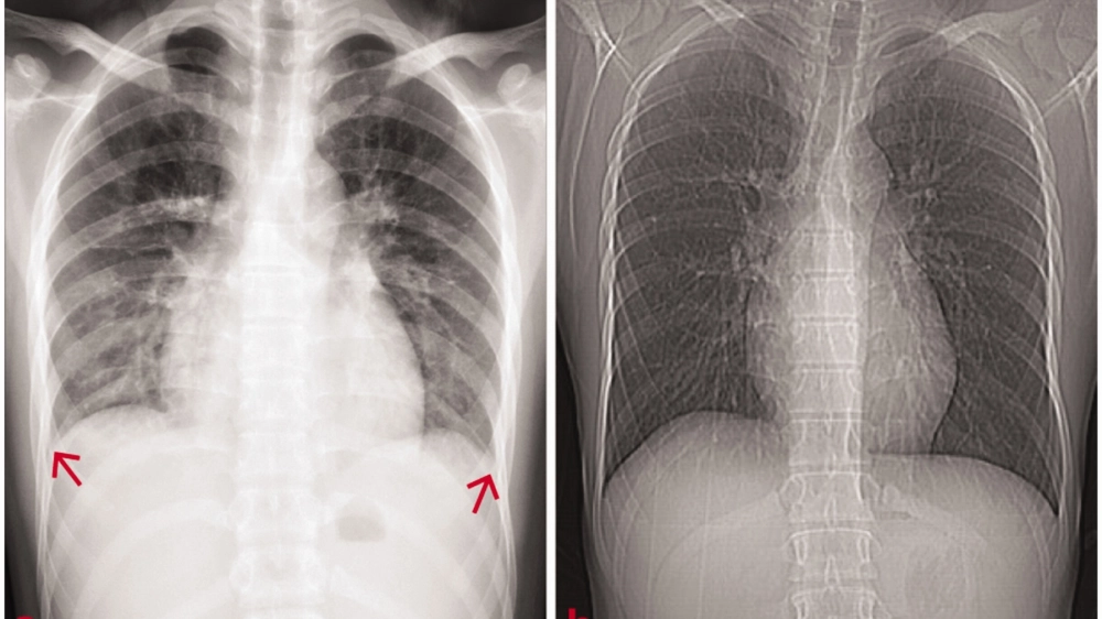 Đọc kết quả xét nghiệm nước tiểu phát hiện bệnh