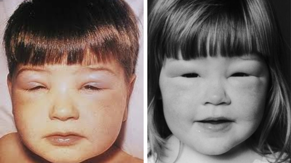 Hình ảnh phù nề ở mặt và chân do viêm cầu thận