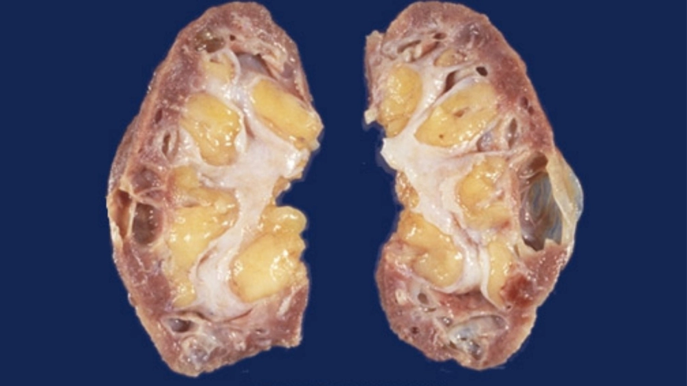 Cấu trúc cầu thận bị tổn thương