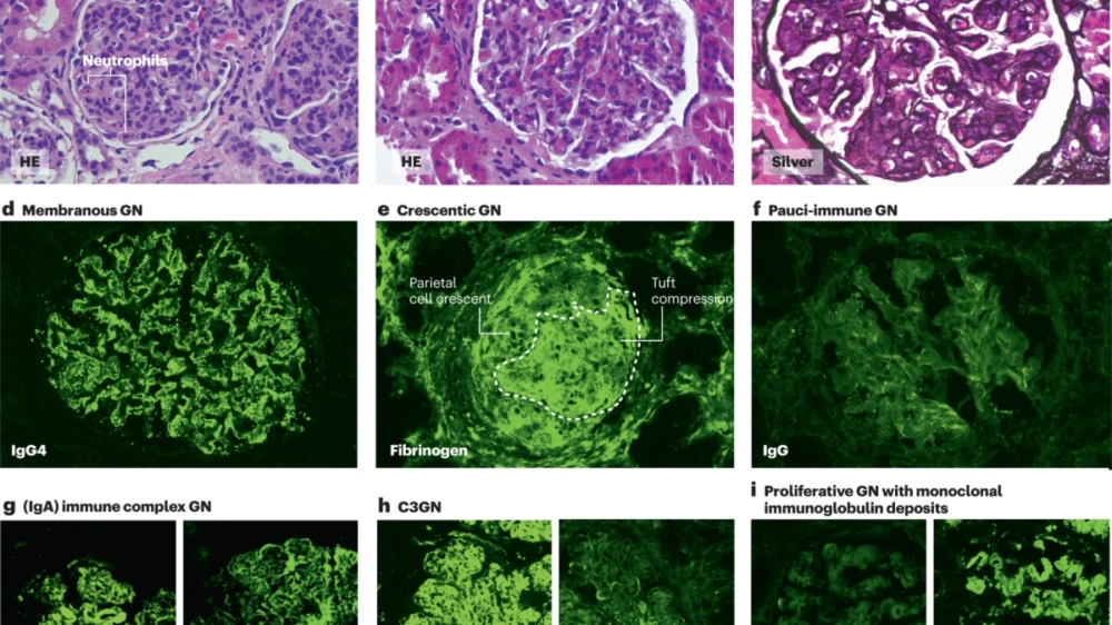 Sơ đồ mô tả nguyên nhân viêm cầu thận dẫn đến tổn thương