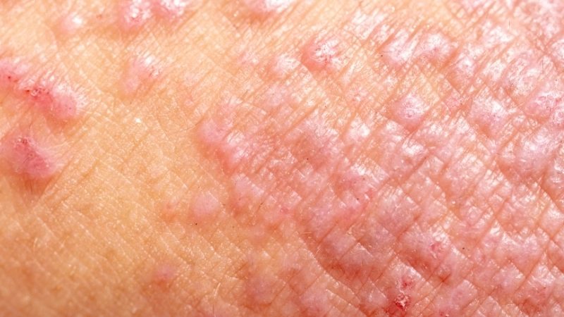 Tổn thương da do viêm da cơ địa ở chân người lớn