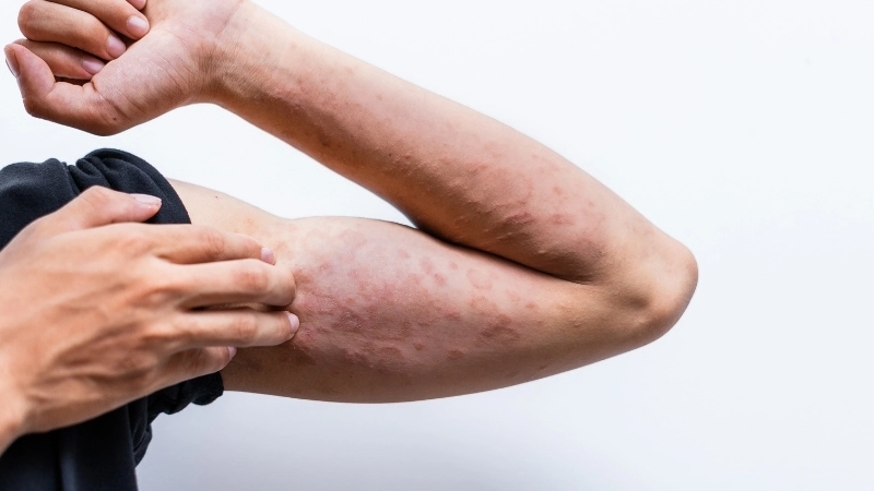 Vùng da phát ban do viêm da cơ địa ở mặt người lớn