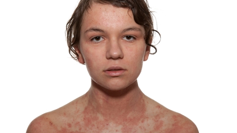 Hình ảnh viêm da cơ địa ở mặt