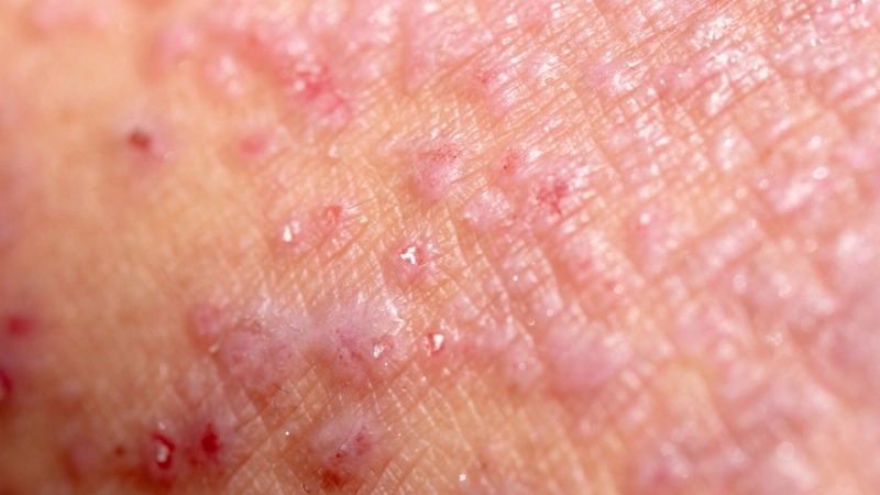 Những nốt phát ban đỏ ở người bị bệnh viêm da cơ địa